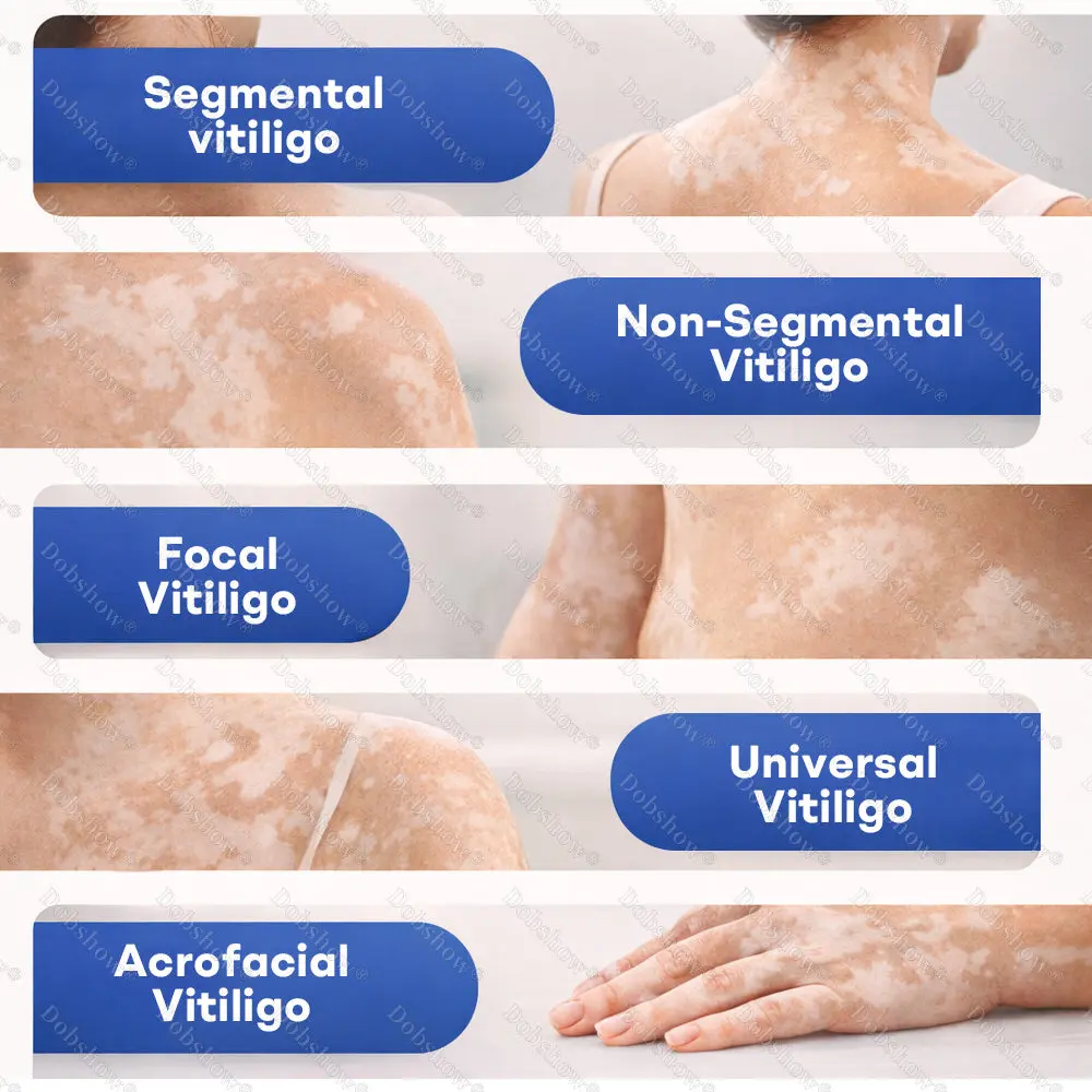 Piperine Vitiligo Repigmentation Spray - Image 4