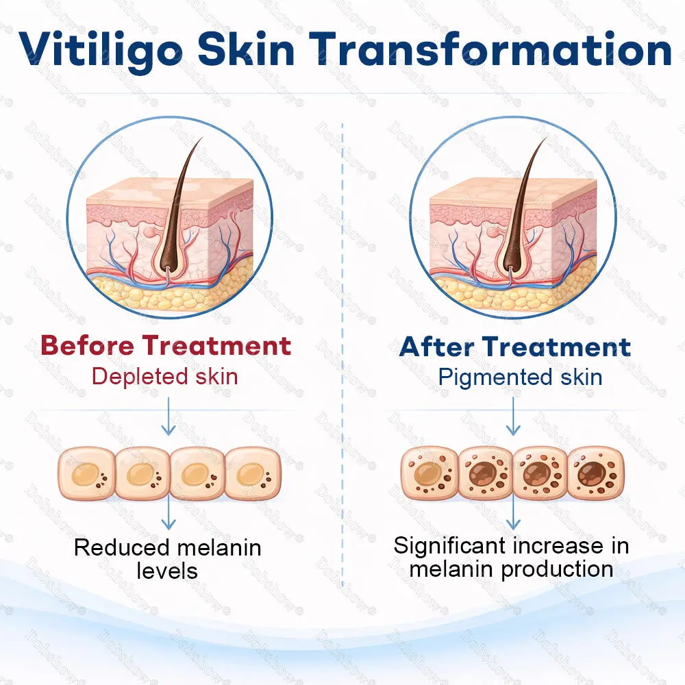 Piperine Vitiligo Repigmentation Spray - Image 2