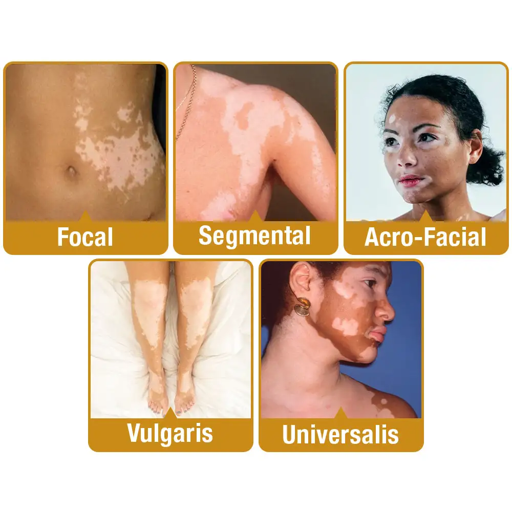 VitiGO Bee Venom Treatment Cream - Image 8