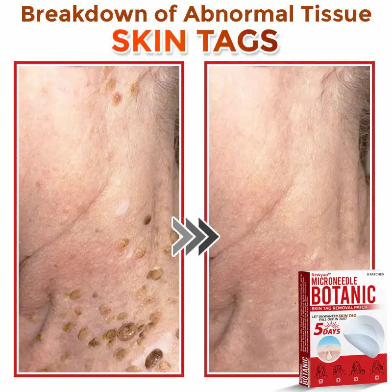 MicroNeedle Botanic Skin Tag Removal Patch - Image 6