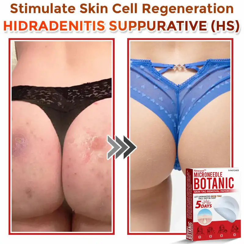 MicroNeedle Botanic Skin Tag Removal Patch - Image 9