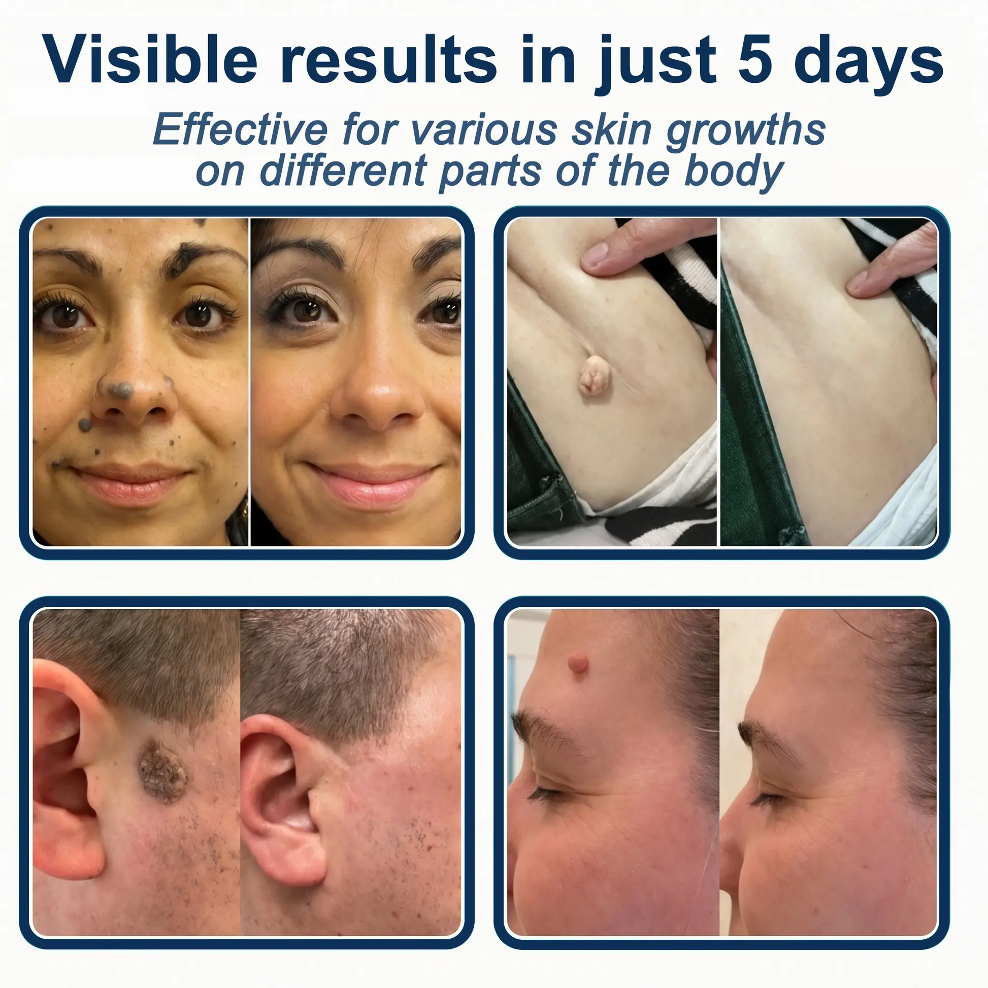 2-in-1 Microneedle & Hydrocolloid Patch - Image 3