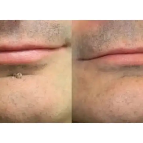 2-in-1 Microneedle & Hydrocolloid Patch - Image 12