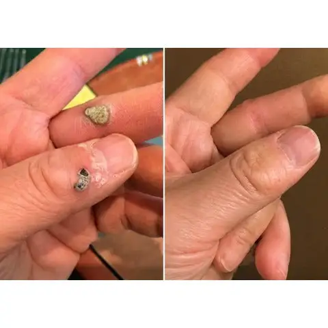 2-in-1 Microneedle & Hydrocolloid Patch - Image 5