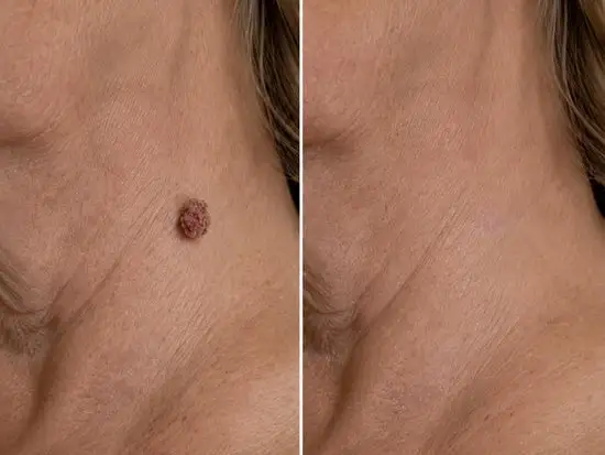 2-in-1 Microneedle & Hydrocolloid Patch - Image 6