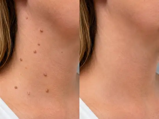 2-in-1 Microneedle & Hydrocolloid Patch - Image 7