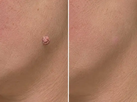 2-in-1 Microneedle & Hydrocolloid Patch - Image 9