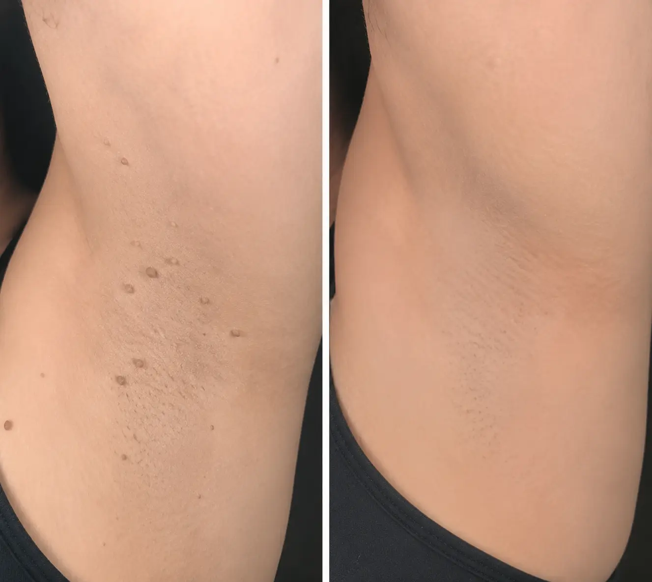 2-in-1 Microneedle & Hydrocolloid Patch - Image 13