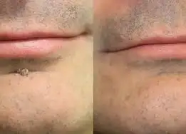 2-in-1 Microneedle & Hydrocolloid Patch - Image 11
