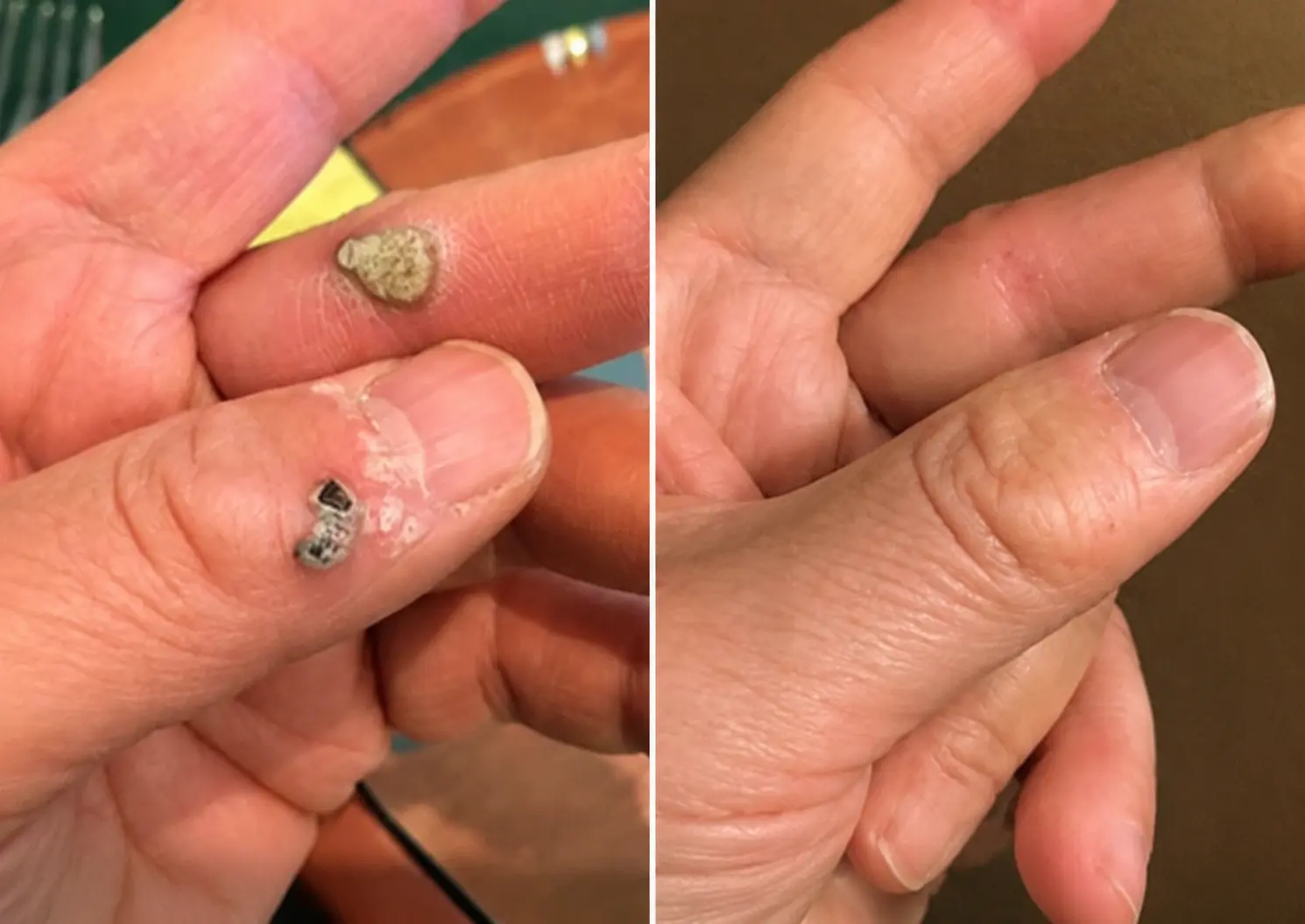 2-in-1 Microneedle & Hydrocolloid Patch - Image 9