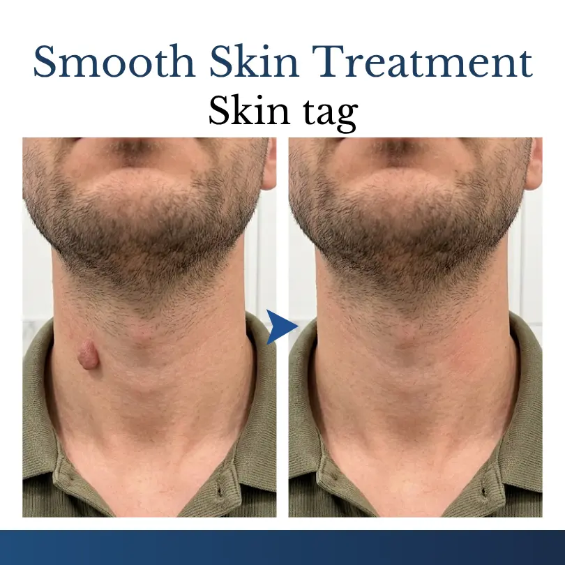 DermFixPro 2-in-1 Microneedle & Hydrocolloid Patch - Image 6