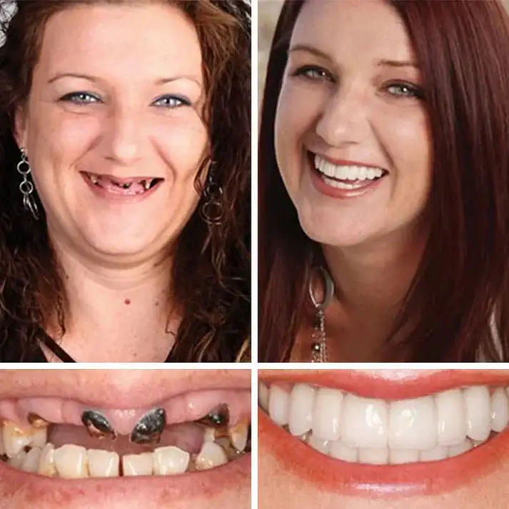 Natural Smile Upgrade - Image 11