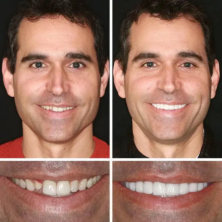 Natural Smile Upgrade - Image 7
