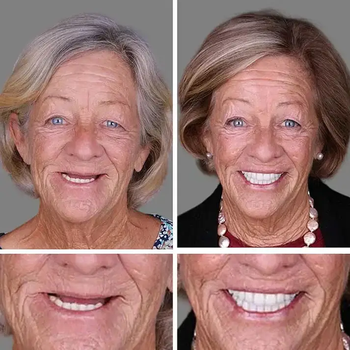 Natural Smile Upgrade - Image 8