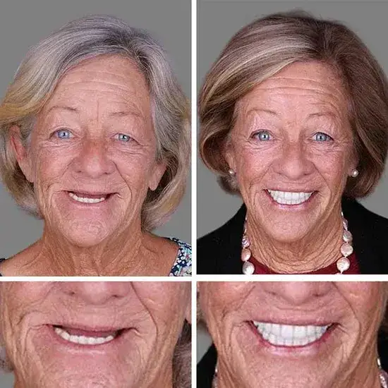 Custom-Fit Smile Support Kit - Image 20