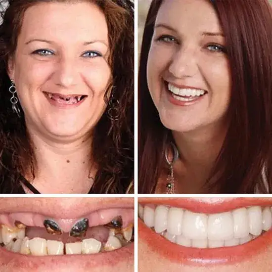 Custom-Fit Smile Support Kit - Image 21