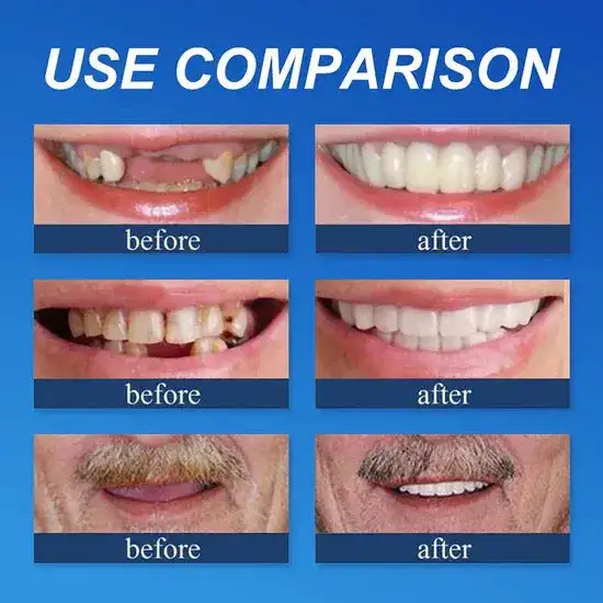 Custom-Fit Smile Support Kit - Image 6
