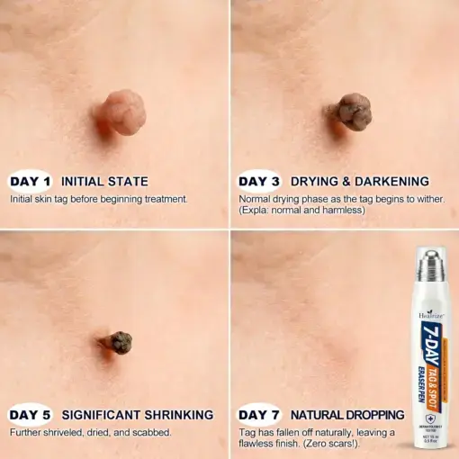 7-Day Skin Tag & Spot Eraser Painless & Scar-Free Advanced Imperfection Removal Rollerball Pen - Image 5
