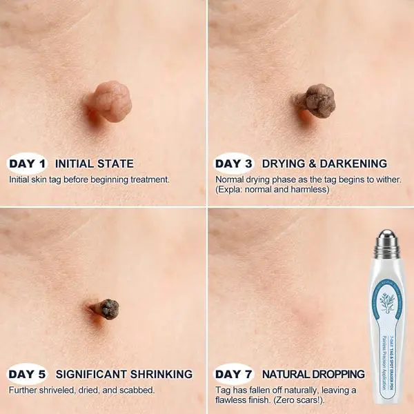 7-Day Skin Tag & Spot Eraser Painless & Scar-Free Advanced Imperfection Removal Rollerball Pen - Image 4