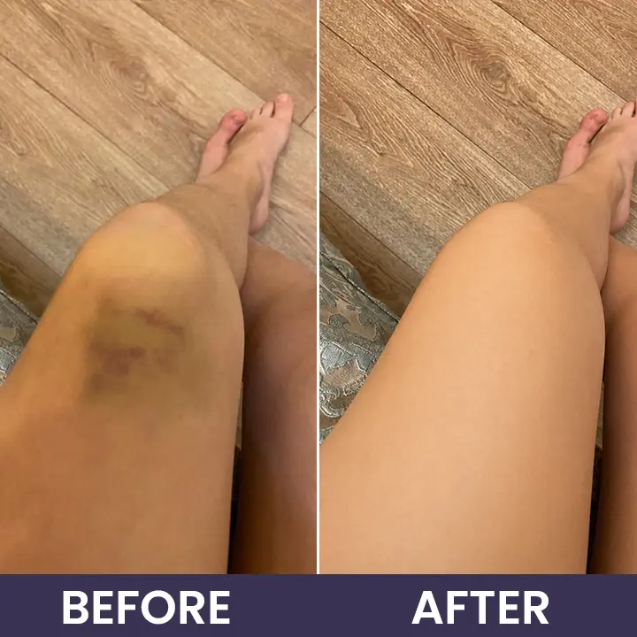 Bruise Recovery Cream - Image 14