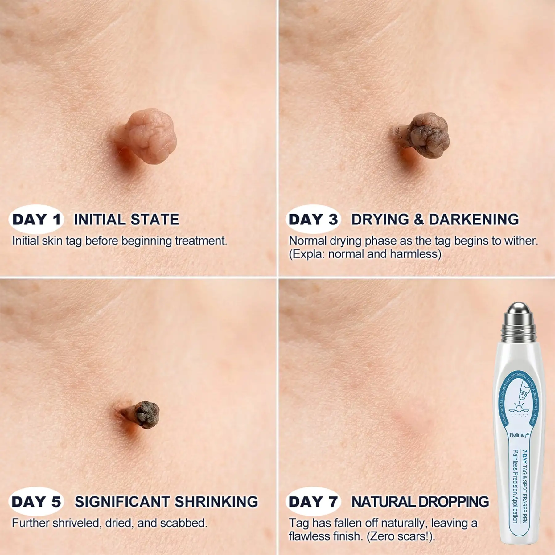 7-Day Roll-On for Skin Spots and Skin Tags – Pain-Free & Scar-Free - Image 3