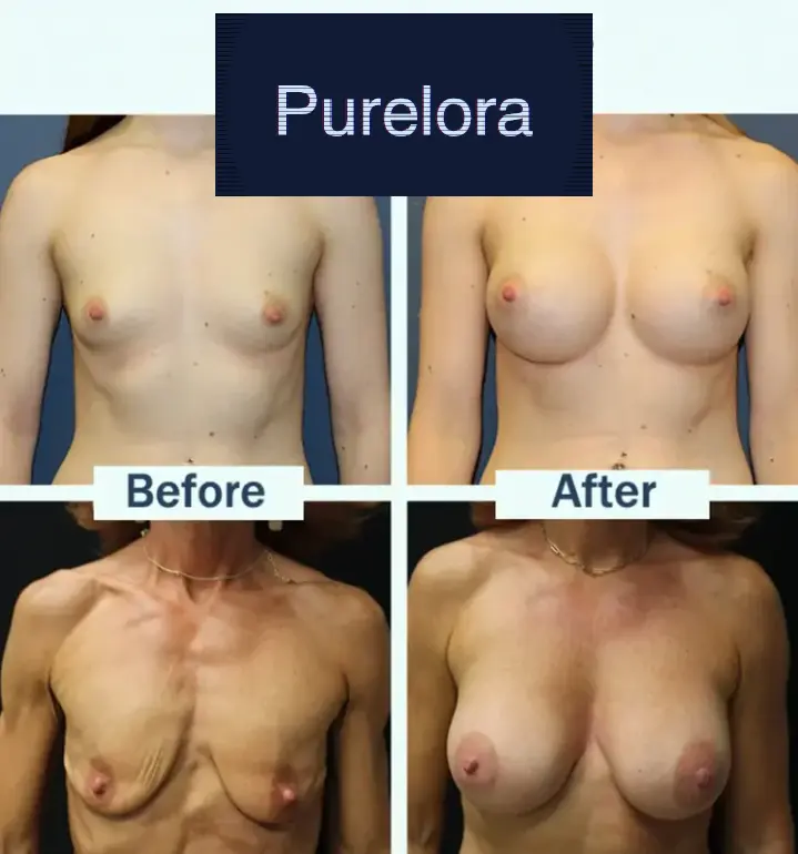 Targeted Breast Enhancement Advanced Nano Microneedle Patch - Image 3