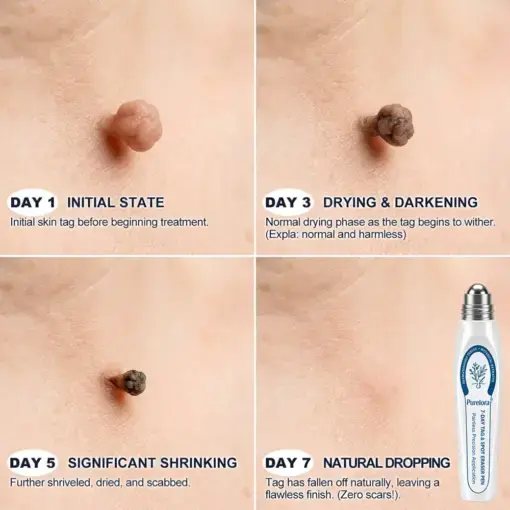 ๐-๐๐๐ ๐๐ธ๐ข๐ง ๐๐๐ด & ๐๐ฉ๐ค๐ญ ๐๐ซ๐๐ฌ๐๐ซ Painless & Scar-Free Advanced Imperfection Remova๐ Ro๐๐erba๐๐ Pen - Image 4
