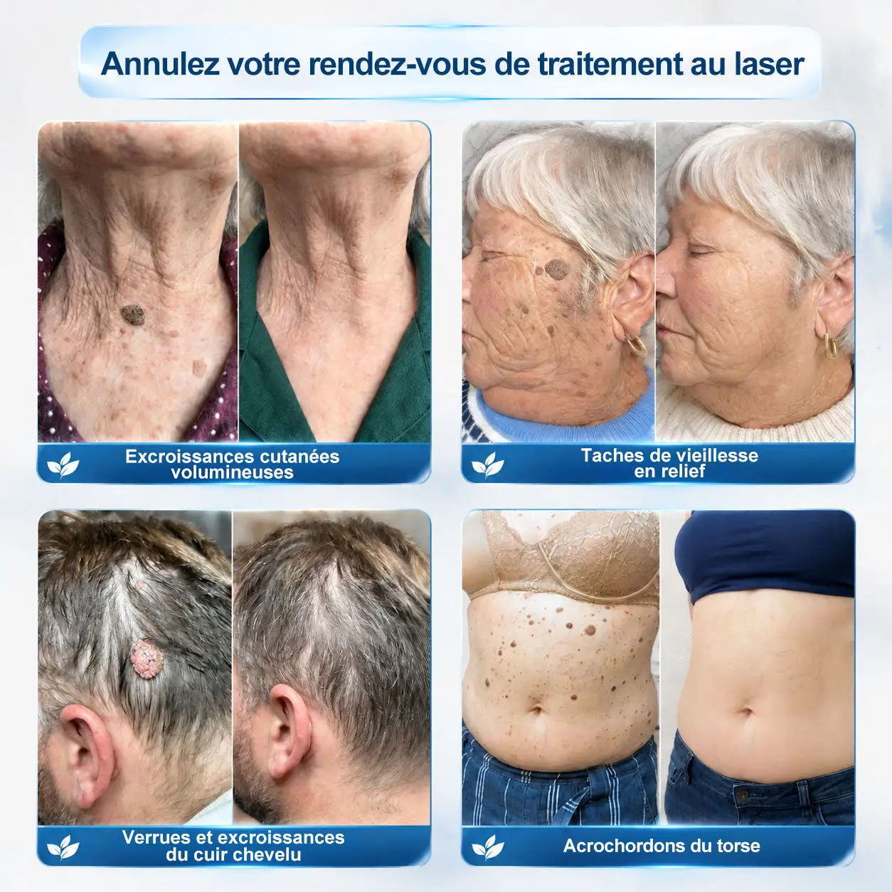 Éliminateur d'Excroissances Cutanées & de Taches en 7 Jours Sans Douleur & Sans Cicatrice - Image 2