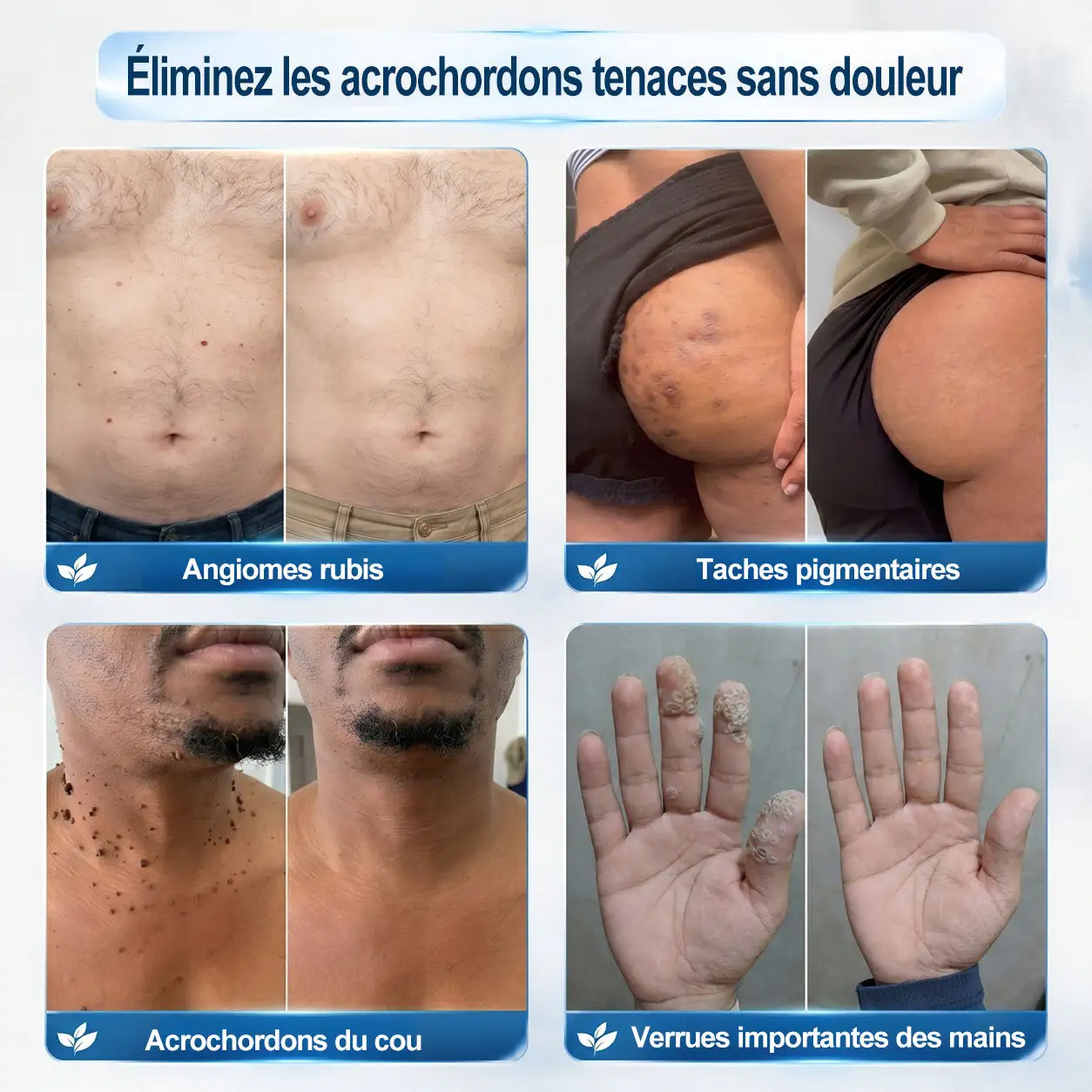 Éliminateur d'Excroissances Cutanées & de Taches en 7 Jours Sans Douleur & Sans Cicatrice - Image 3