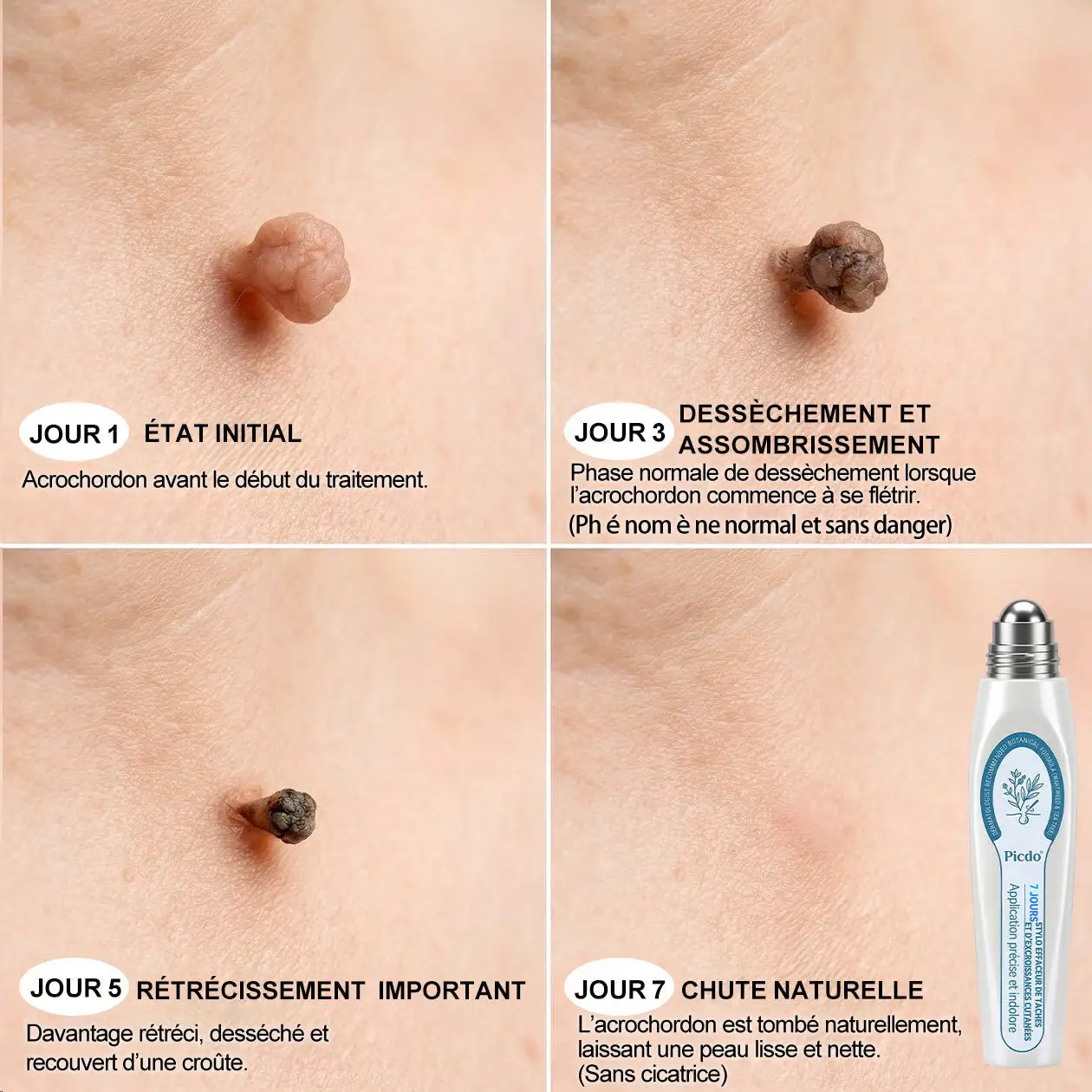Éliminateur d'Excroissances Cutanées & de Taches en 7 Jours Sans Douleur & Sans Cicatrice - Image 4