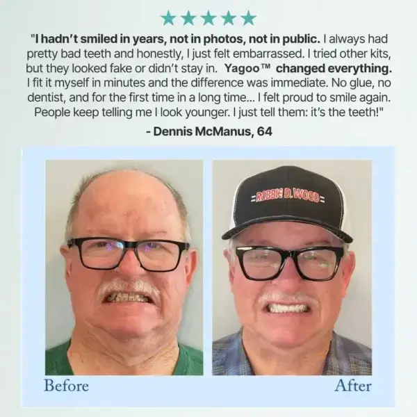Advanced Customized Full Denture Set - Image 14