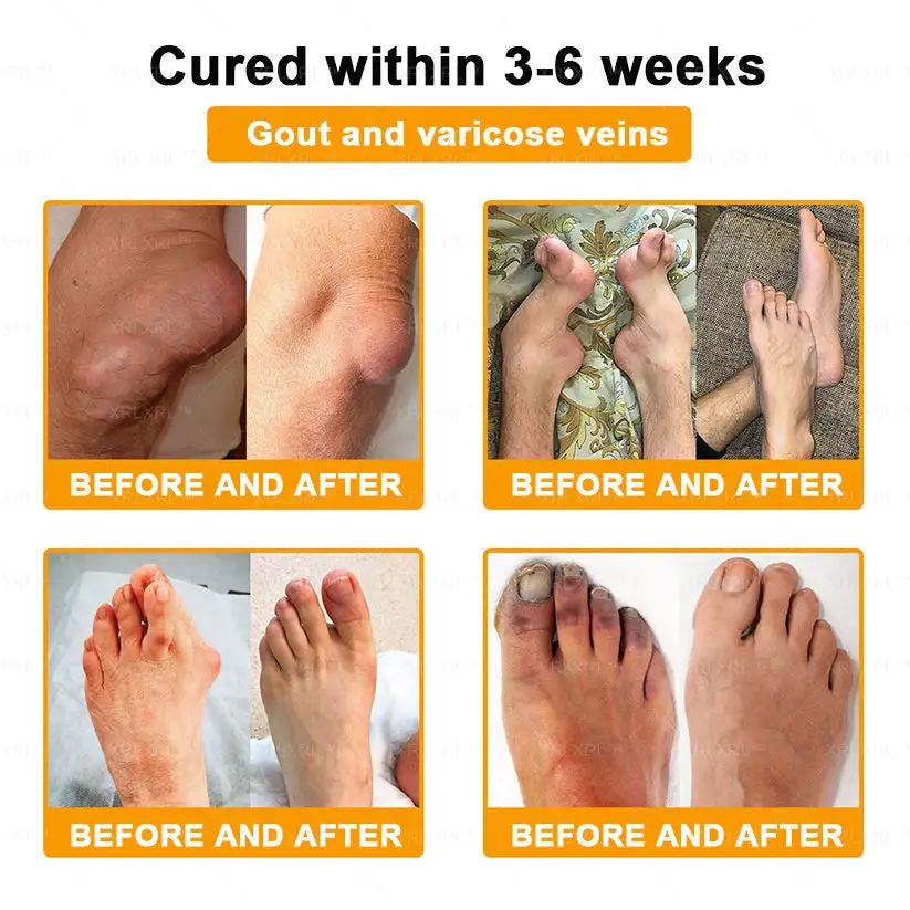 Bee Venom Pain-Relief Bone Healing Cream - Image 2