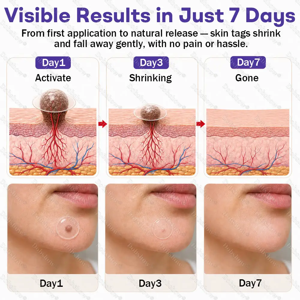 Wart and Mole Removal Microneedle Patch - Image 6
