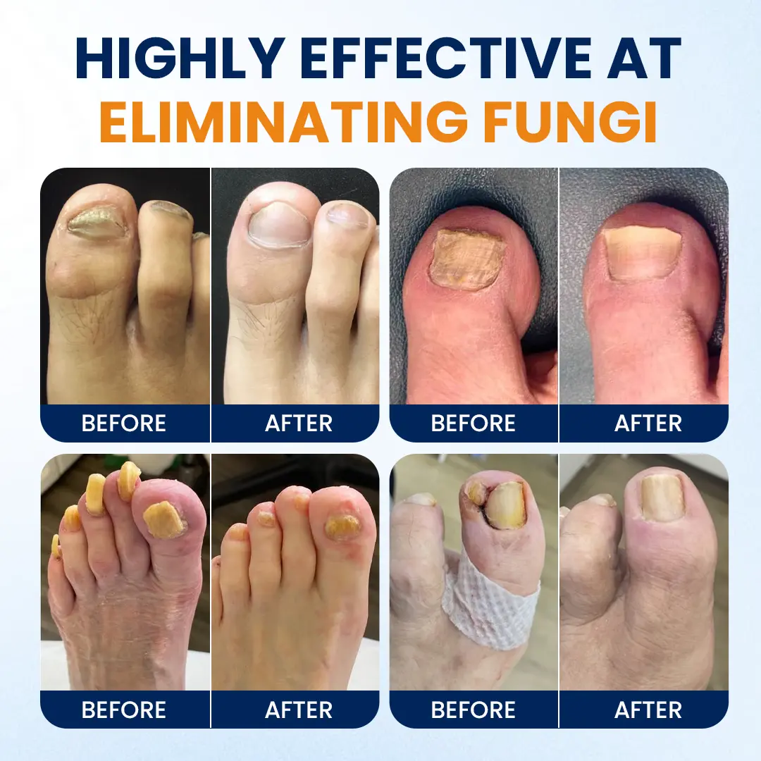 Nail fungus relief spray - Image 2